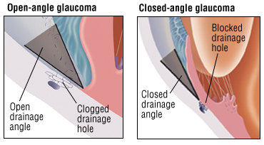 Open Angle Glaucoma Glaucoma Specialists